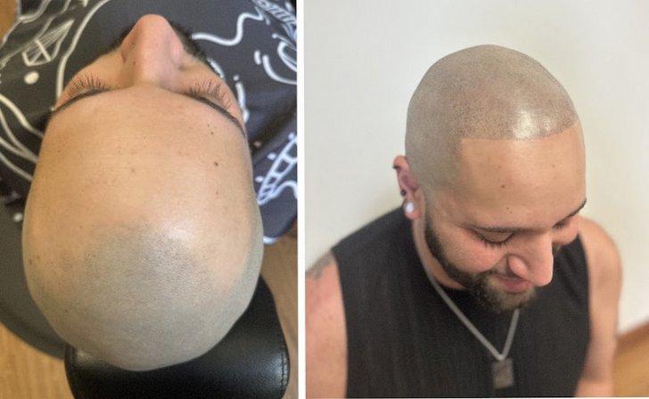 Sacred Skull Scalp Micropigmentation