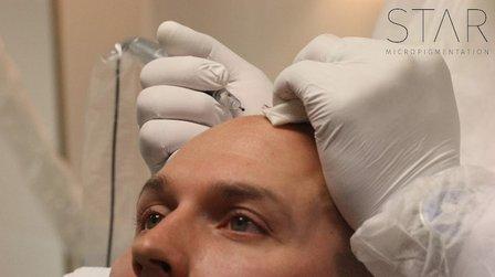 STAR Micropigmentation