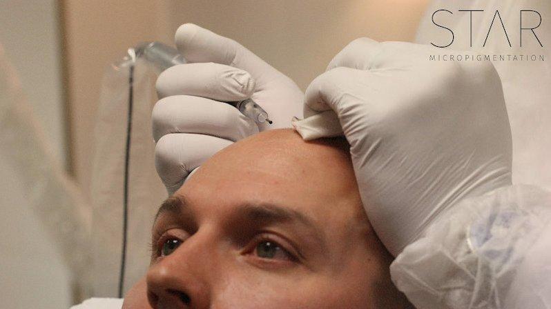 STAR Micropigmentation
