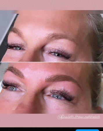 Flawless brow aesthetics