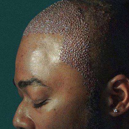 Hair Transplant Design