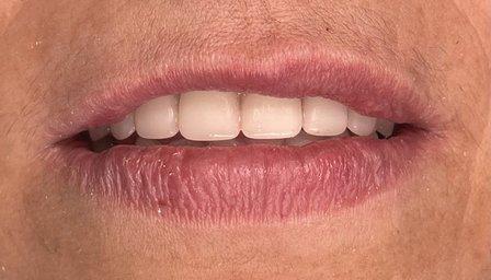 Tampa Dental Implants