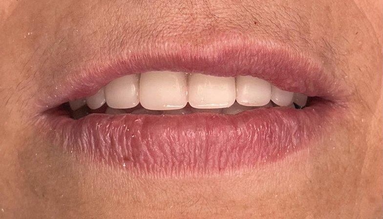 Tampa Dental Implants