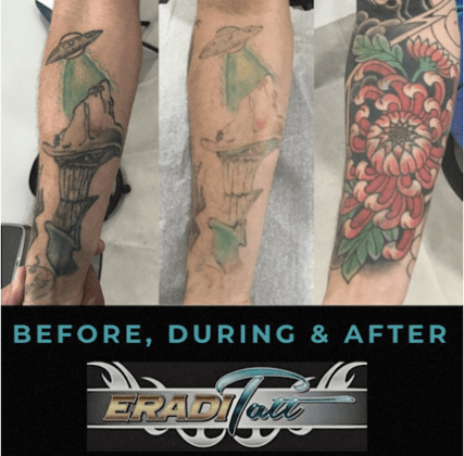 EradiTatt Tattoo Removal of Tampa