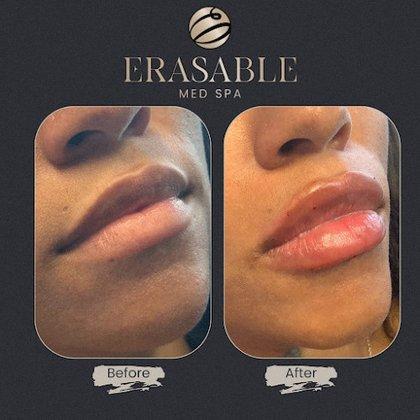 Erasable Med Spa