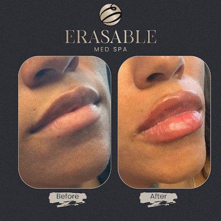Erasable Med Spa