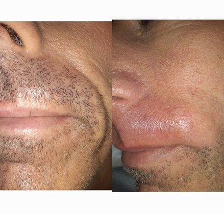 Electric Beauty electrolysis