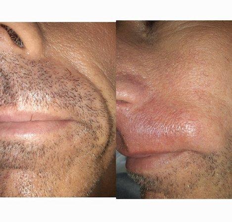 Electric Beauty electrolysis