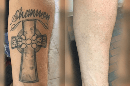 ReversaTatt Tattoo Removal