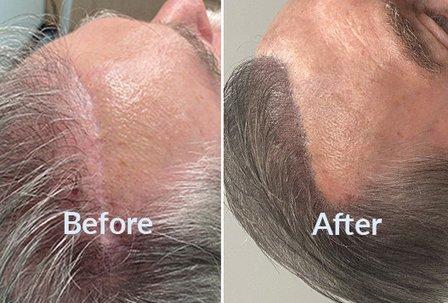 Ultra Scalp Micropigmentation