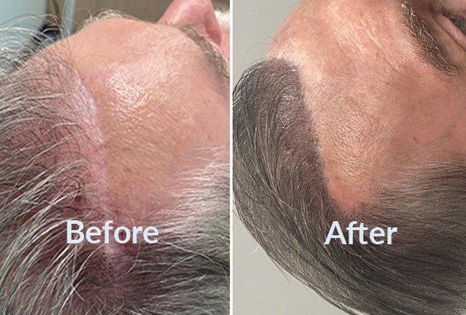 Ultra Scalp Micropigmentation