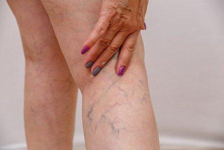 Vein Doctor Tampa