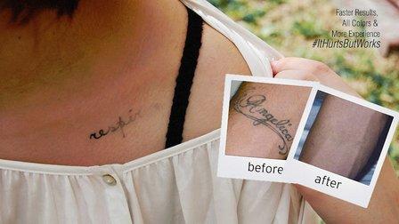 EradiTatt Tattoo Removal of Bradenton/Sarasota