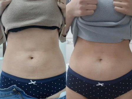 Fat Freeze Away & Rejuvenation Center by Elite Spa
