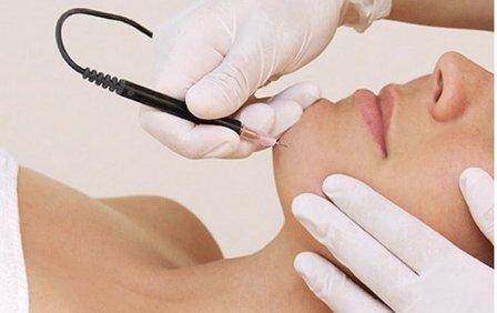 Camille's Electrolysis