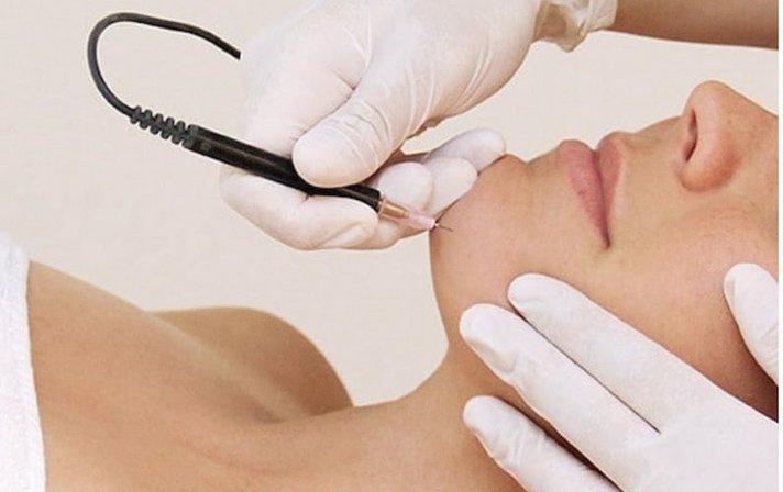 Camille's Electrolysis