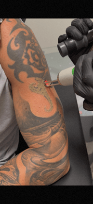 REVIVE Tattoo Removal & Skin Health